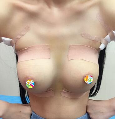 假体隆胸术后恢复3个月纪实