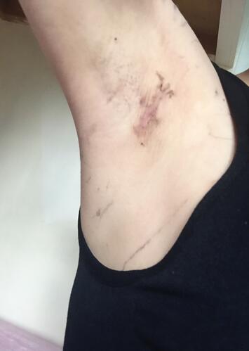 假体隆胸术后恢复3个月纪实