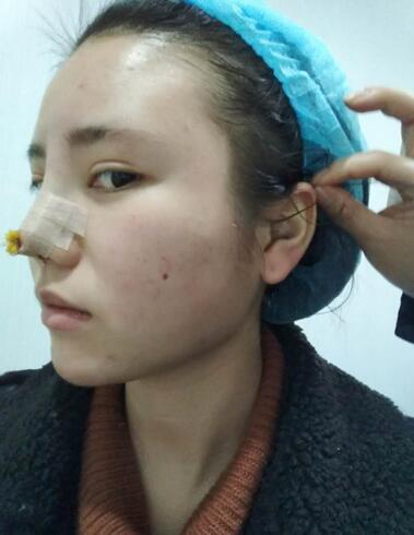 耳软骨垫鼻尖一个月图