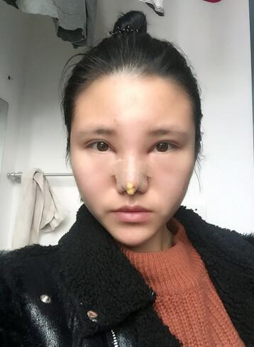 耳软骨垫鼻尖一个月图