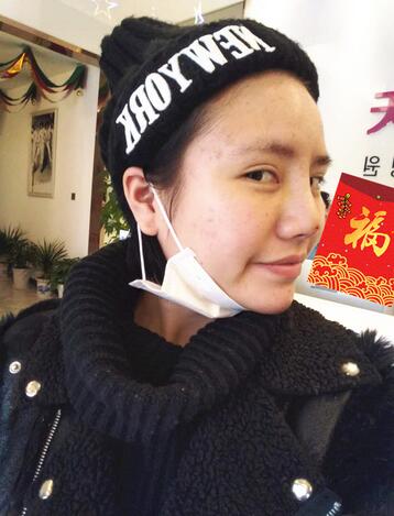 耳软骨垫鼻尖一个月图