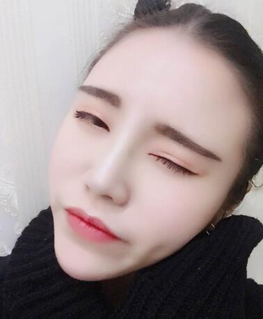 耳软骨垫鼻尖一个月图