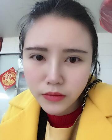 耳软骨垫鼻尖一个月图