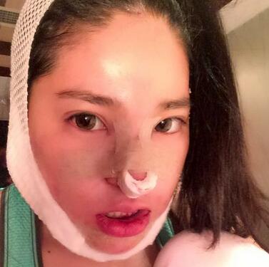 隆鼻整形2个月恢复日记 硅胶隆鼻+鼻翼缩小