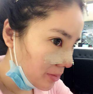 隆鼻整形2个月恢复日记 硅胶隆鼻+鼻翼缩小