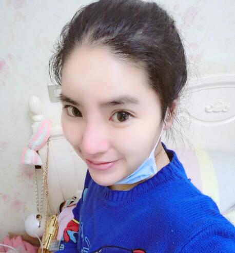 隆鼻整形2个月恢复日记 硅胶隆鼻+鼻翼缩小