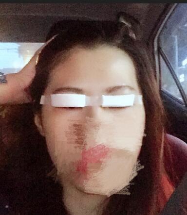 切开重睑术恢复过程图