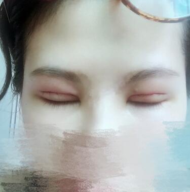 切开重睑术恢复过程图