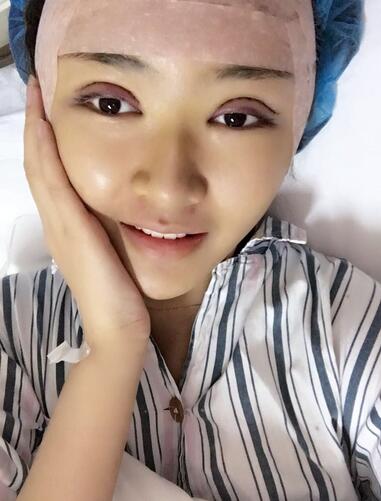 割双眼皮的果前后对比 2个月恢复记录