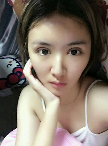 割双眼皮的果前后对比 2个月恢复记录