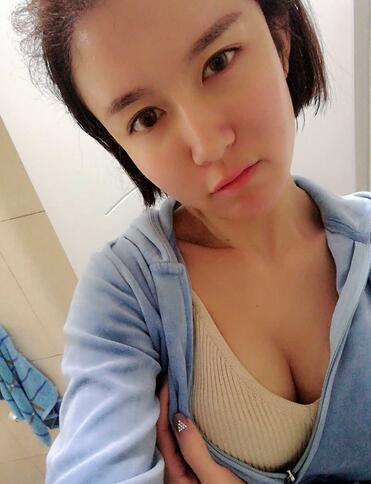 自体脂肪隆胸恢复过程分享