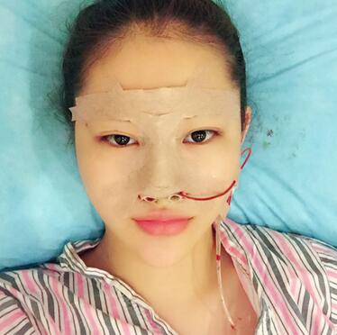 隆鼻整形手术恢复过程图 满月啦~