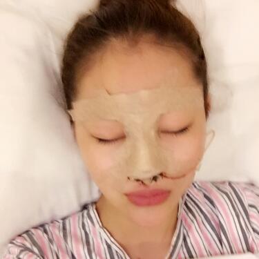 隆鼻整形手术恢复过程图 满月啦~