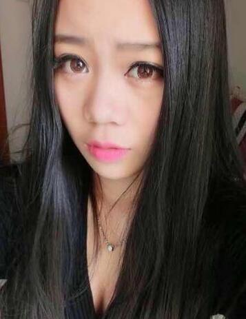 隆鼻拆线后鼻子图片 硅胶隆鼻+鼻翼缩小恢复经历