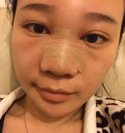 隆鼻拆线后鼻子图片 硅胶隆鼻+鼻翼缩小恢复经历