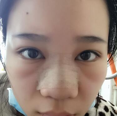 隆鼻拆线后鼻子图片 硅胶隆鼻+鼻翼缩小恢复经历