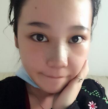 隆鼻拆线后鼻子图片 硅胶隆鼻+鼻翼缩小恢复经历