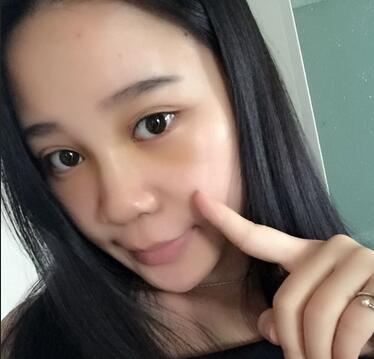 隆鼻拆线后鼻子图片 硅胶隆鼻+鼻翼缩小恢复经历