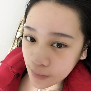 隆鼻拆线后鼻子图片 硅胶隆鼻+鼻翼缩小恢复经历