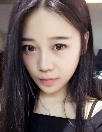 隆鼻拆线后鼻子图片 硅胶隆鼻+鼻翼缩小恢复经历