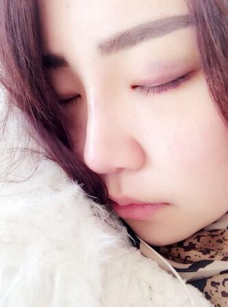 耳软骨垫鼻尖三个月图 耳软骨垫鼻尖+硅胶隆鼻