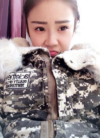 耳软骨垫鼻尖三个月图 耳软骨垫鼻尖+硅胶隆鼻