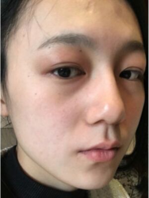 切开双眼皮+去眼袋果对比，术后精神多了
