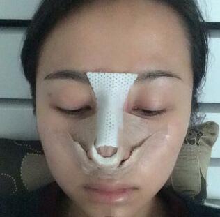 耳软骨垫鼻尖+隆鼻+鼻翼缩小3个月了