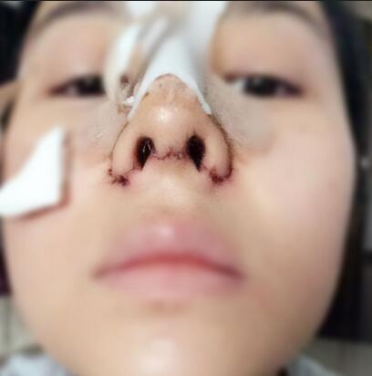 耳软骨垫鼻尖+隆鼻+鼻翼缩小3个月了