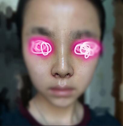 耳软骨垫鼻尖+隆鼻+鼻翼缩小3个月了