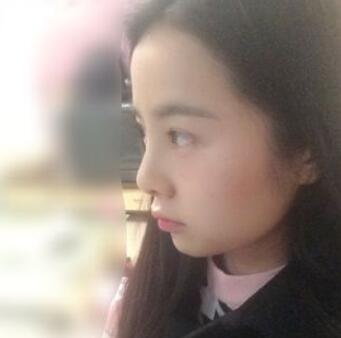 耳软骨垫鼻尖+隆鼻+鼻翼缩小3个月了