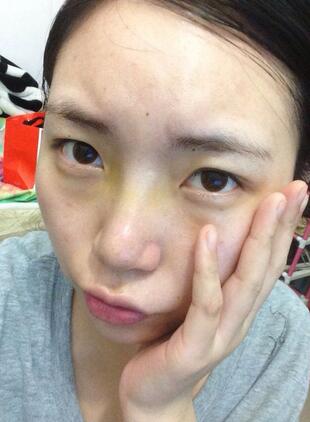 隆鼻整形真实恢复期图片 硅胶隆鼻+鼻头缩小