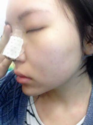 隆鼻整形真实恢复期图片 硅胶隆鼻+鼻头缩小