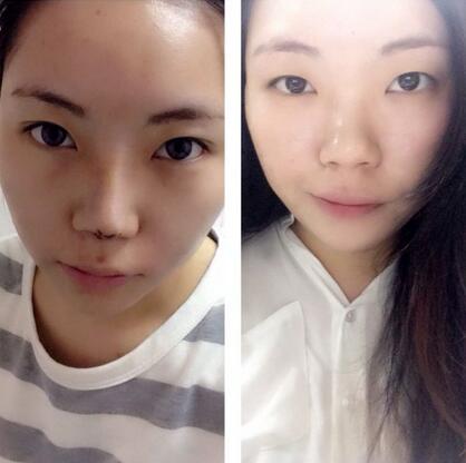 隆鼻整形真实恢复期图片 硅胶隆鼻+鼻头缩小