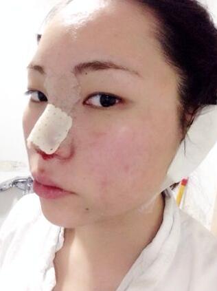 隆鼻整形真实恢复期图片 硅胶隆鼻+鼻头缩小