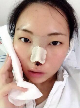 隆鼻整形真实恢复期图片 硅胶隆鼻+鼻头缩小