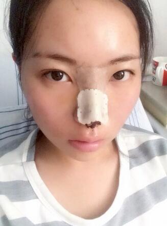 隆鼻整形真实恢复期图片 硅胶隆鼻+鼻头缩小