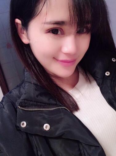 切开双眼皮+开眼角15天果图 双眼皮多项整形消肿过程