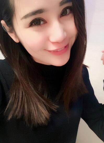 切开双眼皮+开眼角15天果图 双眼皮多项整形消肿过程