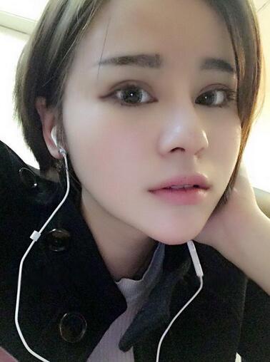 切开双眼皮+开眼角15天果图 双眼皮多项整形消肿过程