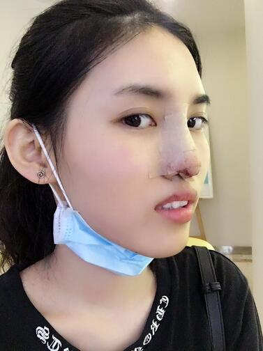 鼻子做完假体恢复图 假体隆鼻+耳软骨垫鼻尖半年了