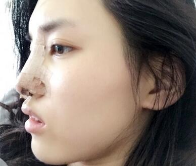 鼻子做完假体恢复图 假体隆鼻+耳软骨垫鼻尖半年了