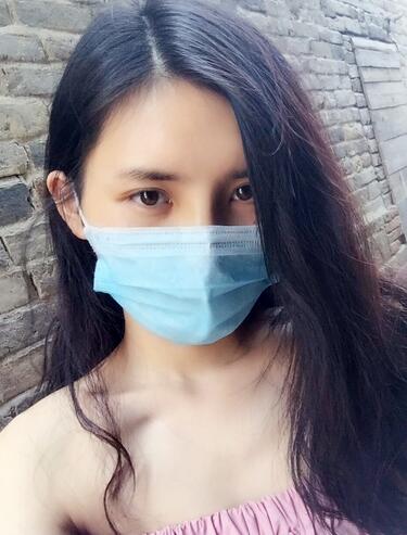 鼻子做完假体恢复图 假体隆鼻+耳软骨垫鼻尖半年了