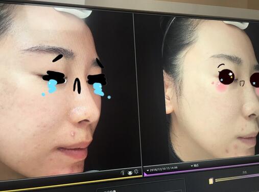 做完光子嫩肤恢复图片 果满满