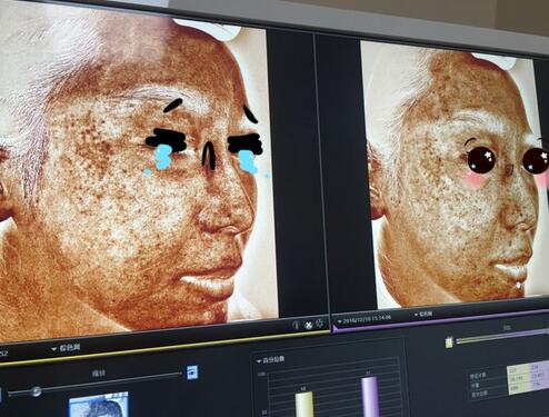 做完光子嫩肤恢复图片 果满满