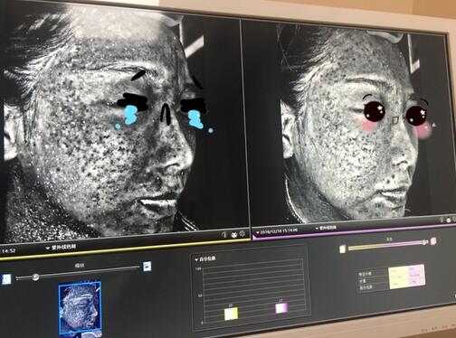 做完光子嫩肤恢复图片 果满满