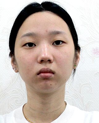切开双眼皮+垫下巴前后对比照，无比自然