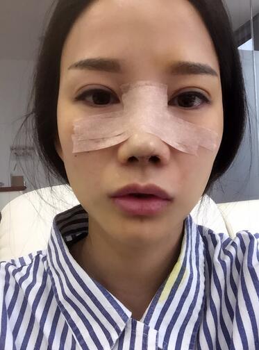 隆鼻整形真实恢经历 晒图啦！