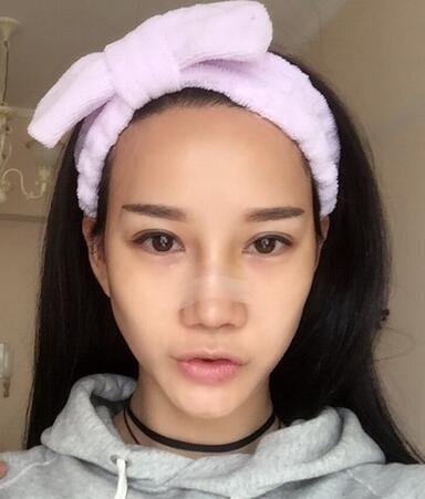 隆鼻整形真实恢经历 晒图啦！