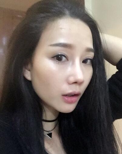 隆鼻整形真实恢经历 晒图啦！